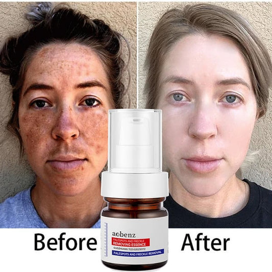 Vitamin C Whitening Freckles Face Cream Remove Melasma Dark Spots Lighten Melanin